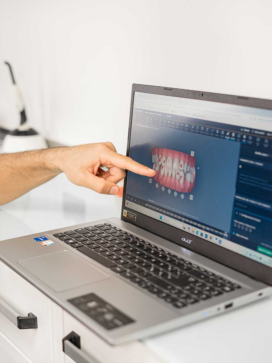 Mano che indica uno schermo di laptop Acer con un modello 3D di denti e gengive. Il laptop è su una superficie chiara. Mano che indica uno schermo di laptop Acer con un modello 3D di denti e gengive. Il laptop è su una superficie chiara.